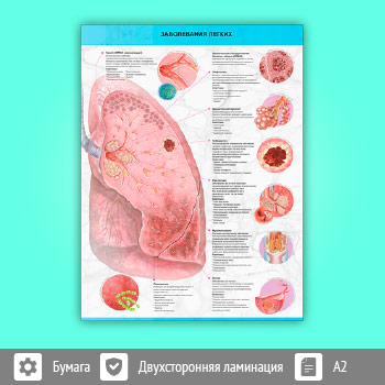 Плакат «Заболевания легких» (М-30, 1 лист, A2)